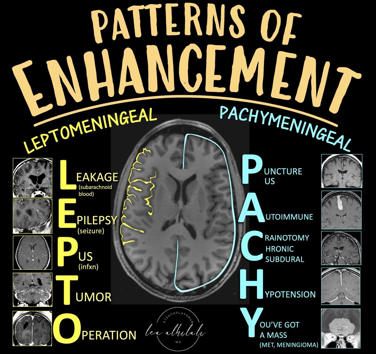 teachplaygrub's tweet photo. Need a DURABLE way to remember what causes DURAL enhancement?

Feeling left behind when it comes to leptomeningeal disease?

Here’s an easy way to remember the differential diagnoses for the two types of meningeal enhancement:

LEPTOMENINGEAL
Remember:
L = Leakage (subarachnoid hemorrhage)
E = Epilepsy (recent seizure)
P = Pus (infection, either bacterial, viral or granulomatous/fungal)
T = Tumor (leptomeningeal metastatic dz)
O = Operation (post operative)

PACHYMENINGEAL
Remember
P = Puncture (recent LP), Pus (subdural empyema)
A = Autoimmune (sarcoidosis, IgG4)
C = Craniotomy (post-op), Chronic subdural
H = Hypotension (intracranial hypotension)
Y = You’ve got a mass (mets, usually from direct bony extension, meningioma)

Now you’ve got a lot information PACH-ed into an easy & memorable mnemonic!