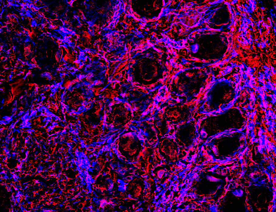 Science Signaling (@scisignal) on Twitter photo B cells can drive #NeuropathicPain and allodynia after nerve injury by secreting IgG that accumulates and activates Fc gamma receptors within sensory neurons, shows new preclinical work from scientists at <a href="/MDAndersonNews/">MD Anderson Cancer Center</a>. <a href="/DrPeterGrace/">Peter Grace, Ph.D.</a> <a href="/MJLacagnina/">Michael Lacagnina</a> scim.ag/8ov B cells can drive #NeuropathicPain and allodynia after nerve injury by secreting IgG that accumulates and activates Fc gamma receptors within sensory neurons, shows new preclinical work from scientists at <a href="/MDAndersonNews/">MD Anderson Cancer Center</a>. <a href="/DrPeterGrace/">Peter Grace, Ph.D.</a> <a href="/MJLacagnina/">Michael Lacagnina</a> scim.ag/8ov