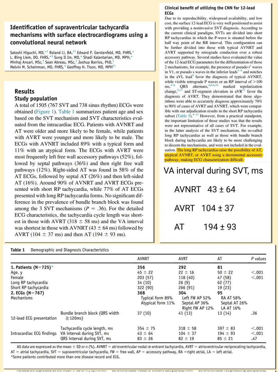 First things first. Long RP or short RP tachycardia? The term is counterintuitive with regards to atrial tachycardia. AT drives ventricles in one direction and PR interval is relevant to be used.  Click the picture to see the results here.