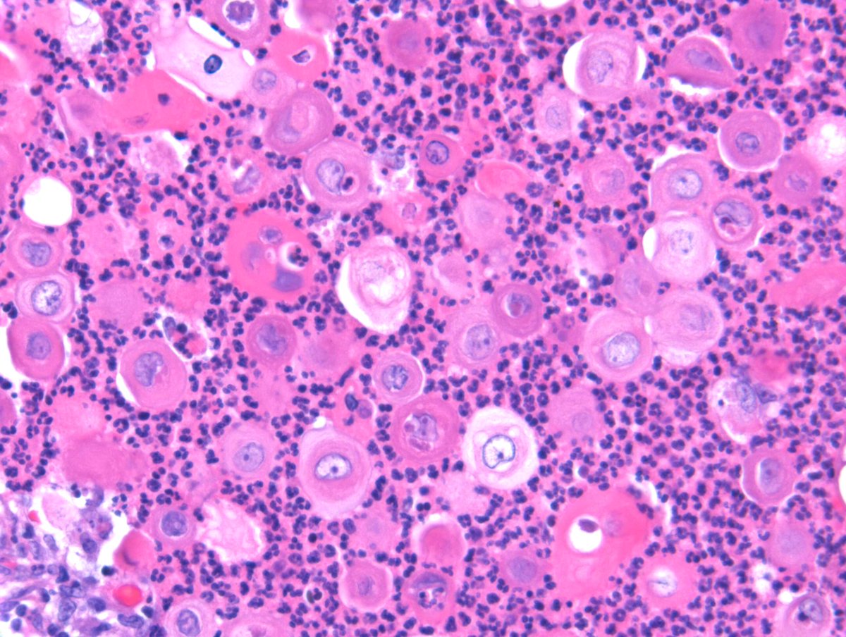 RACARR51's tweet photo. 2024 Wk39 RAC9152 Skin #TooCloseToDiagnose ? #Dermpath https://t.co/6TD7BJi1Ip