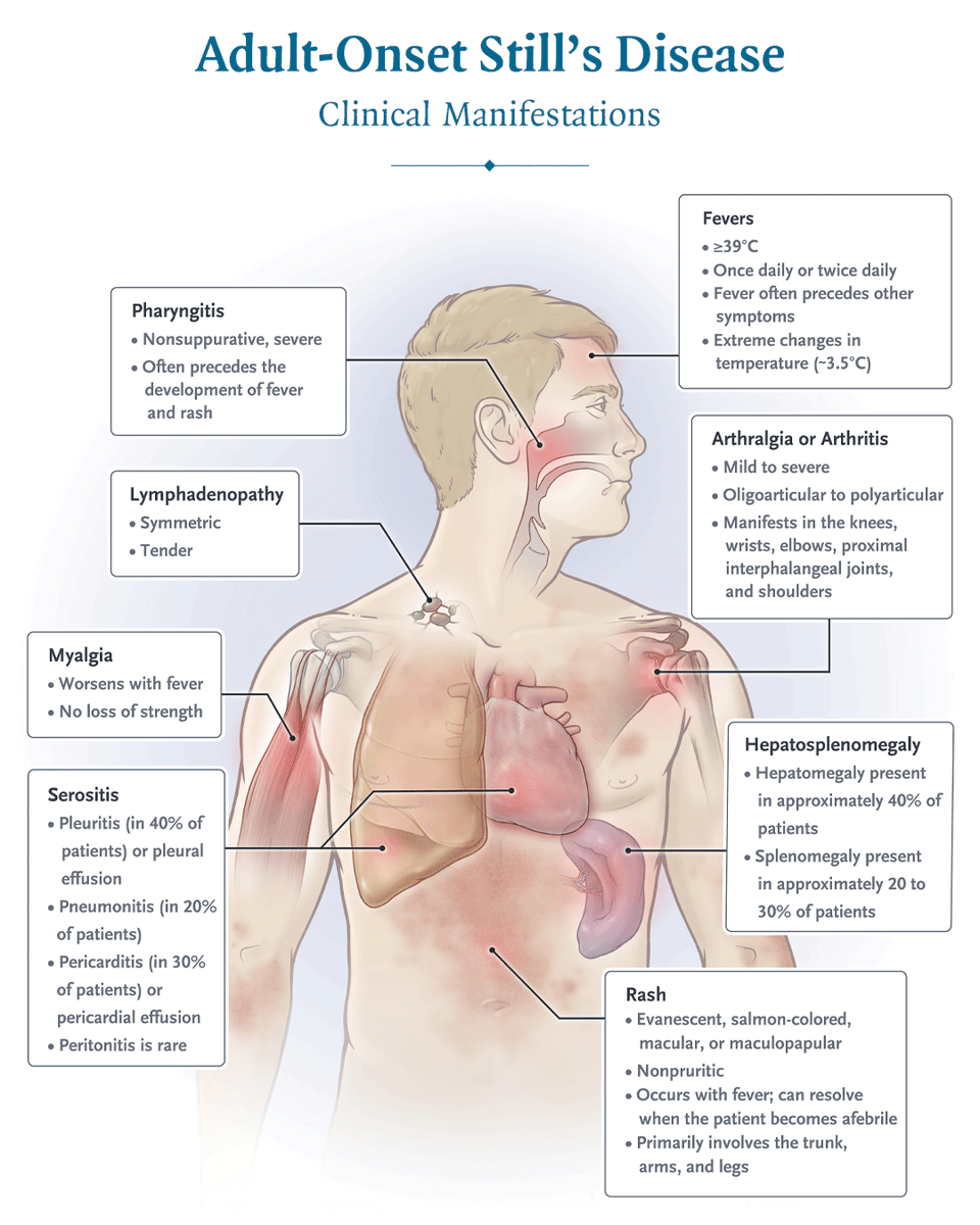 NEJM's tweet photo. Still’s disease is an uncommon, systemic, autoinflammatory disease of uncertain cause. It is often misdiagnosed because of heterogeneous symptoms, including fever, rash, leukocytosis, and arthralgia. Learn more in the latest Interactive Medical Case: https://t.co/vzvnp3Z4Ly https://t.co/WuSbkq3ot7