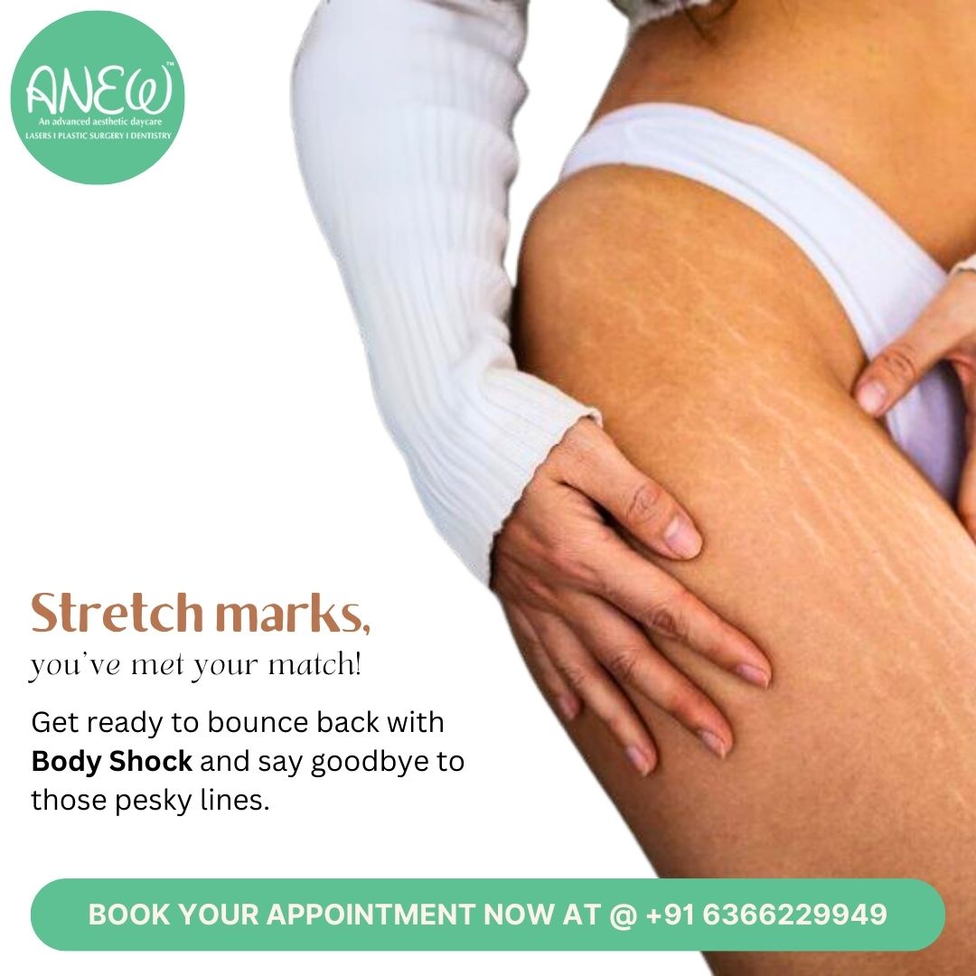 AestheticAnew's tweet photo. Introducing Body Shock – the ultimate solution for reducing stretch marks and revealing smoother, firmer skin! ✨ Our advanced treatment targets stubborn stretch marks, helping to fade them while tightening and revitalizing your skin.#BodyShock #StretchMarkTreatment https://t.co/UlCWdCAUEs