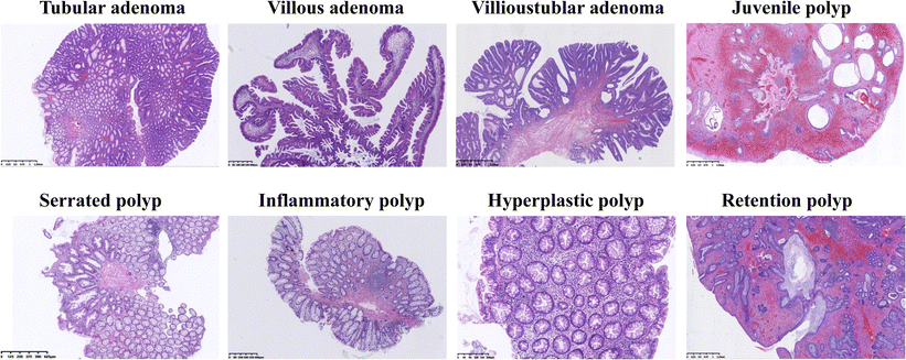 Different Types of Colonic Polyps : In Picture 🔬

link.springer.com/article/10.100…