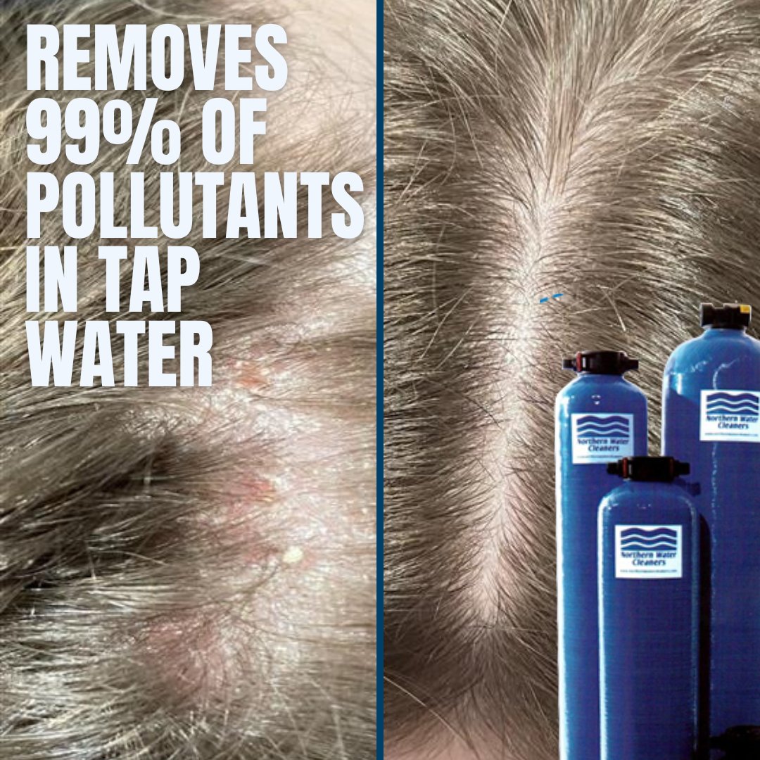 Our customer's daughter struggled with unknown rashes on her skin, unaware that the chlorine in their tap water was to blame. 

Take the first step towards a healthier home, starting with your tap water.

📞 1-877-694-6555

#SkinCareSolutions #WaterWellness #saskwater