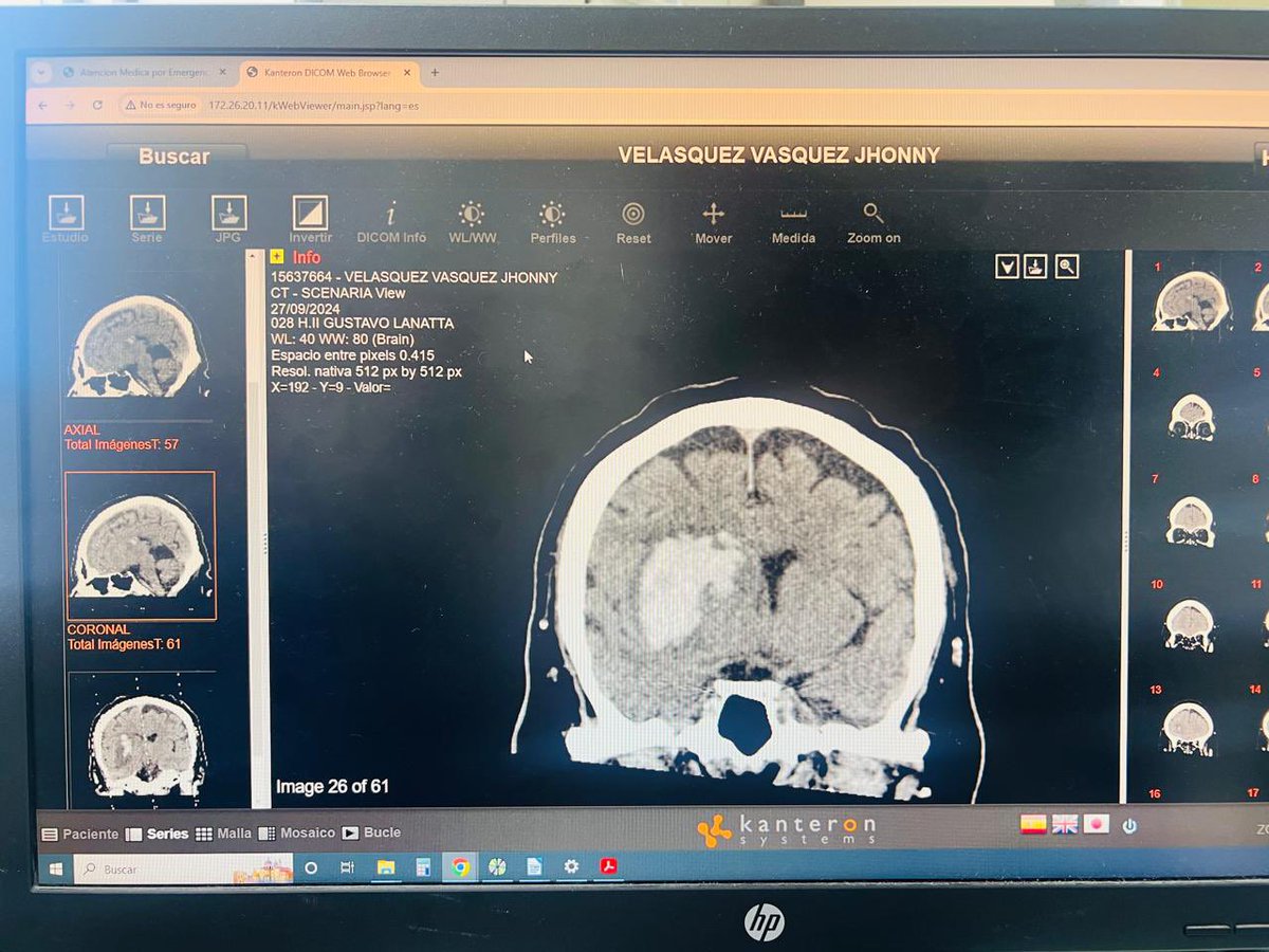 🚨 URGENTE: Hombre diabético con hemorragia en el cerebro necesita traslado a Hospital Sabogal. Está internado en UCI de <a href="/EsSaludPeru/">EsSalud Perú</a> HUACHO y se ESTÁ HINCHANDO porque no lo pueden dializar desde hace 4 días. “Solo dializan en Lima y no hay camas disponibles”

Contacto: 968180170