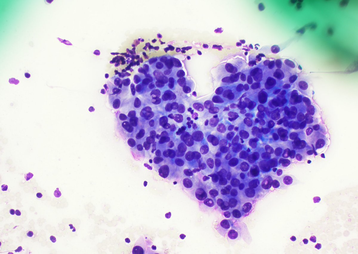 Back in cytoworld covering FNAs with my PD <a href="/cjvand/">Chris VandenBussche</a>