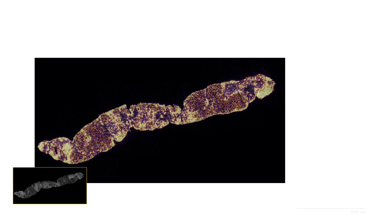 Kicking off an exciting analysis using #SpatialTranscriptomics! Plasmablast cells in immune checkpoint inhibitor-related hepatitis with <a href="/10xGenomics/">10x Genomics</a> #Xenium. Early findings look promising! Amazing support from <a href="/SanMartino_Ge/">Ospedale San Martino Genova</a> and <a href="/UniGenova/">Università di Genova</a> <a href="/AACR/">AACR</a> @SITCcancer #CancerResearch
