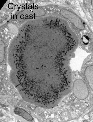 Crystalline light chain myeloma kidney!

LM- Tubules filled with PAS negative casts. Trichrome stain shows casts with needle shaped crystals.

IF: Casts +++ for kappa, neg for lambda.

EM: Tubules contain needle shaped crystals.

80-yr with diabetes, HTN, renal mass, AKI, Cr 7.5