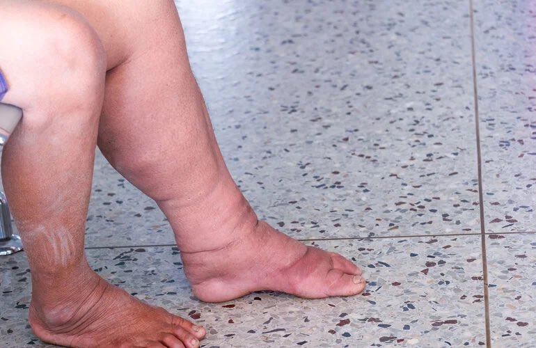 👏🏽 Brazil eliminates lymphatic #filariasis as a public health problem.

Lymphatic filariasis, commonly known as elephantiasis, is a debilitating parasitic disease spread by mosquitoes.
 
ℹ️ Read more: paho.org/en/news/30-9-2…