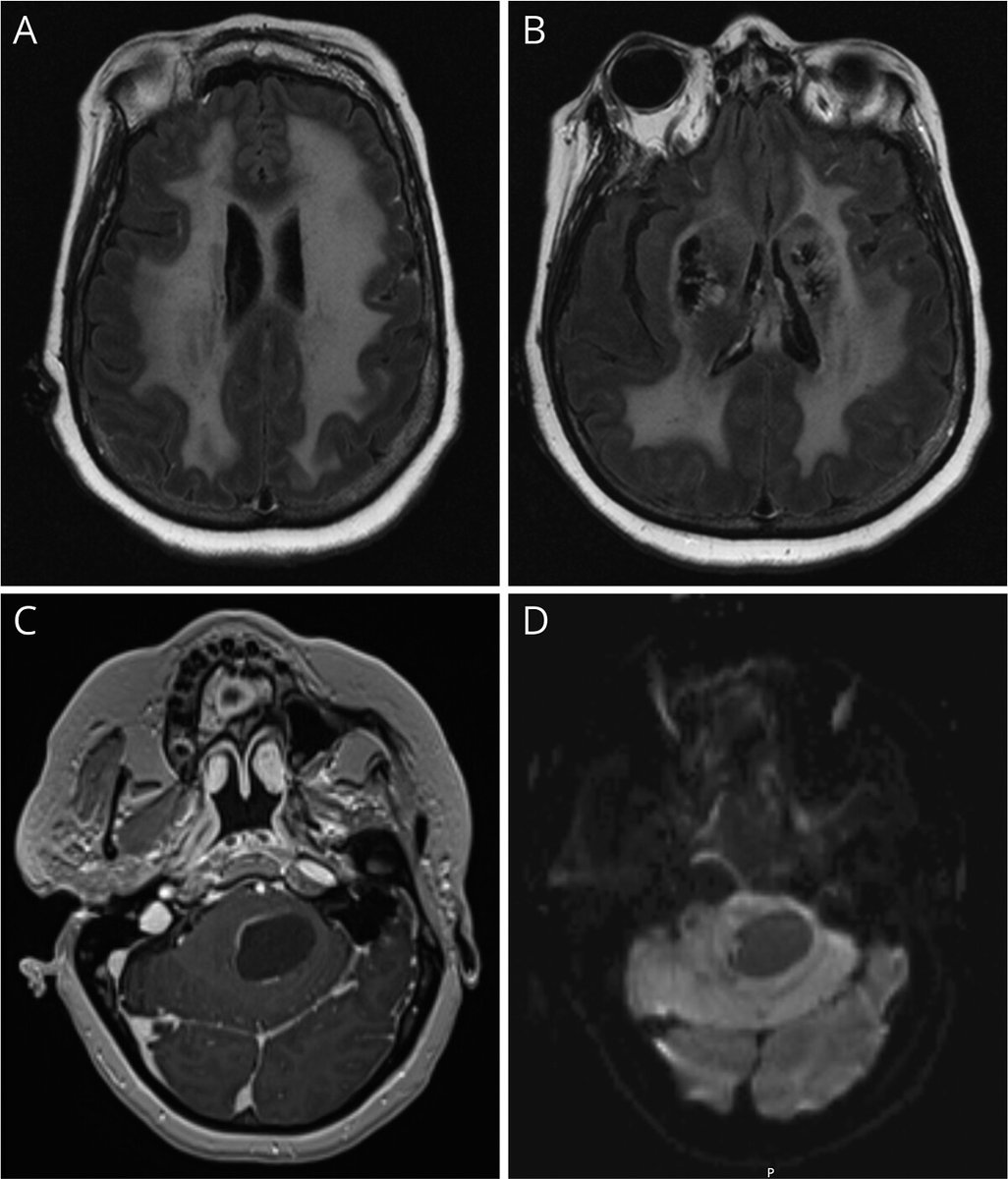 Felipe Jones (@felipejonesmd) on Twitter photo Happy to share this complex case of leukoencephalopathy with calcifications and cysts (LCC) that I saw with the amazing <a href="/JennOligoMyelin/">Jenn Orthmann Murphy</a>. It is important to recognize this radiographic pattern to guide genetic testing and appropriate management. bit.ly/3BkH9ek Happy to share this complex case of leukoencephalopathy with calcifications and cysts (LCC) that I saw with the amazing <a href="/JennOligoMyelin/">Jenn Orthmann Murphy</a>. It is important to recognize this radiographic pattern to guide genetic testing and appropriate management. bit.ly/3BkH9ek