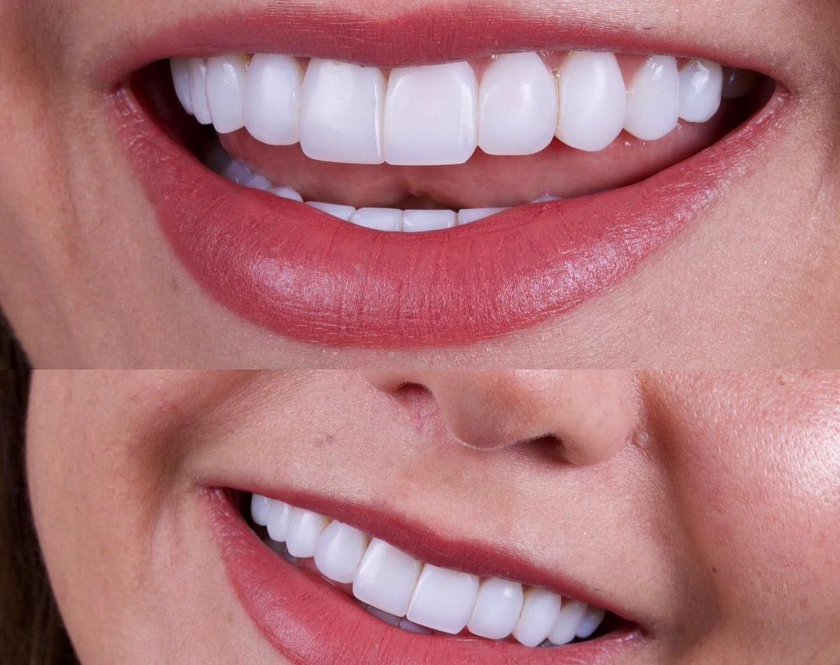 sonriaperfecto's tweet photo. Smile Design Mexico | Aceptamos #Bitcoin pide tu cita de valoración virtual desde cualquier lugar del mundo. Ingresa a https://t.co/JYBPEwHQvm #smile #smiledesign #diseñodesonrisa https://t.co/PkNUuHdyU7