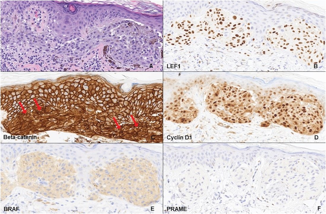 American Journal of Dermatopathology (@ajdp_journal) on Twitter photo #WhatsNewInDermpath
<a href="/BusamDermDx/">Klaus Busam</a> <a href="/MPulitzerMD/">Melissa Pulitzer, MD</a> <a href="/KonstantinosLin/">Konstantinos LinosMD</a> <a href="/MSKCancerCenter/">Memorial Sloan Kettering Cancer Center</a> <a href="/DHPathRes/">Dartmouth Health Pathology Residency</a> <a href="/GeiselMed/">Geisel School of Medicine at Dartmouth</a>
present a cohort of 11 cases of Wnt-activated deep penetrating/plexiform melanocytomas/nevi (DPN) with a junctional component #WhatsNewInDermpath
<a href="/BusamDermDx/">Klaus Busam</a> <a href="/MPulitzerMD/">Melissa Pulitzer, MD</a> <a href="/KonstantinosLin/">Konstantinos LinosMD</a> <a href="/MSKCancerCenter/">Memorial Sloan Kettering Cancer Center</a> <a href="/DHPathRes/">Dartmouth Health Pathology Residency</a> <a href="/GeiselMed/">Geisel School of Medicine at Dartmouth</a>
present a cohort of 11 cases of Wnt-activated deep penetrating/plexiform melanocytomas/nevi (DPN) with a junctional component