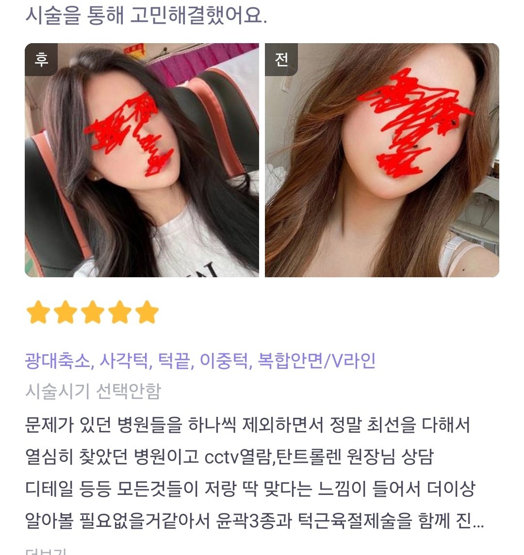 輪郭3種とあごの筋肉切除手術を受けたが、最初むくみがちょっと長く行って心配したが、5?6ヶ月が過ぎてどんどん院長が新しく作ってくれたきれいな輪郭線が出始め、寛大な感じが消えてとても満足です。

#バービートーク #カンナムオンニ #輪郭整形
#Vライン #卵型 #整形垢 #垢抜け