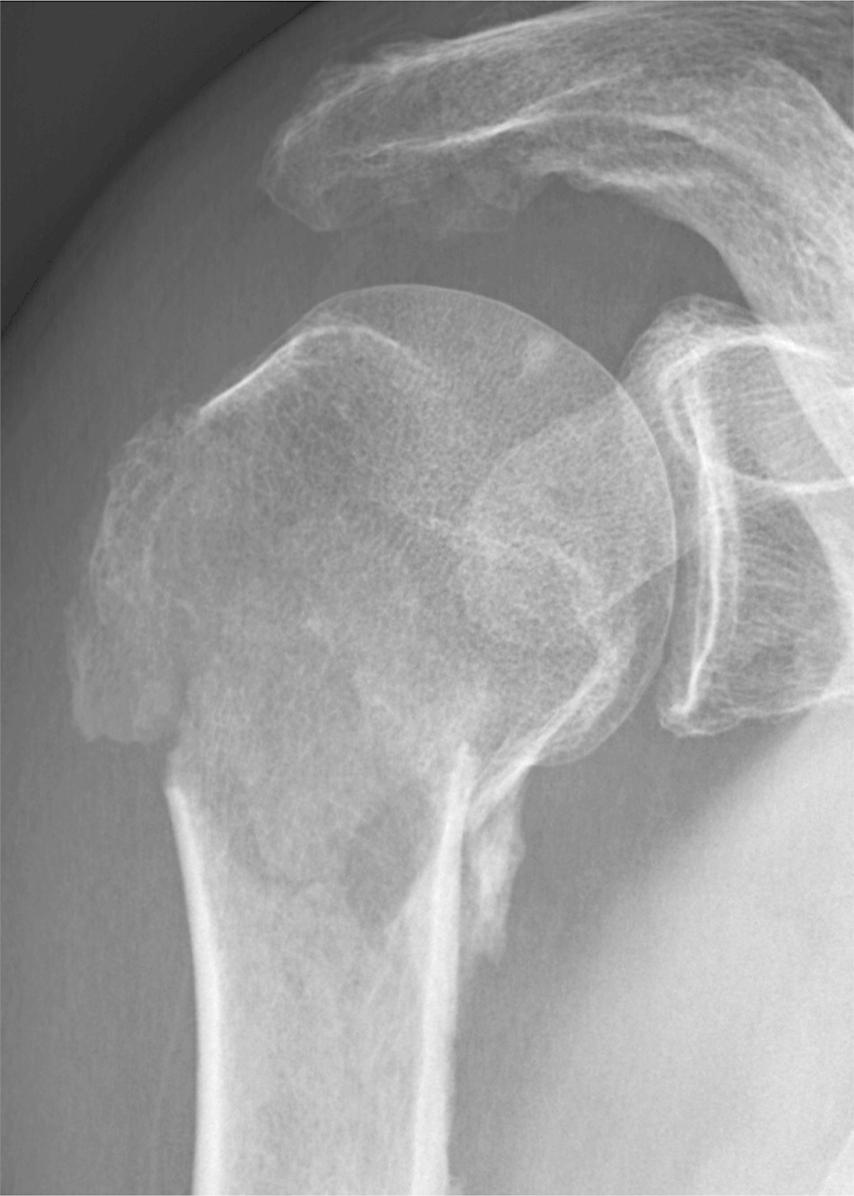Reverse Shoulder Arthroplasty Is Superior to Plate Fixation for Displaced Proximal Humeral Fractures in the Elderly

bit.ly/4eFRtMA