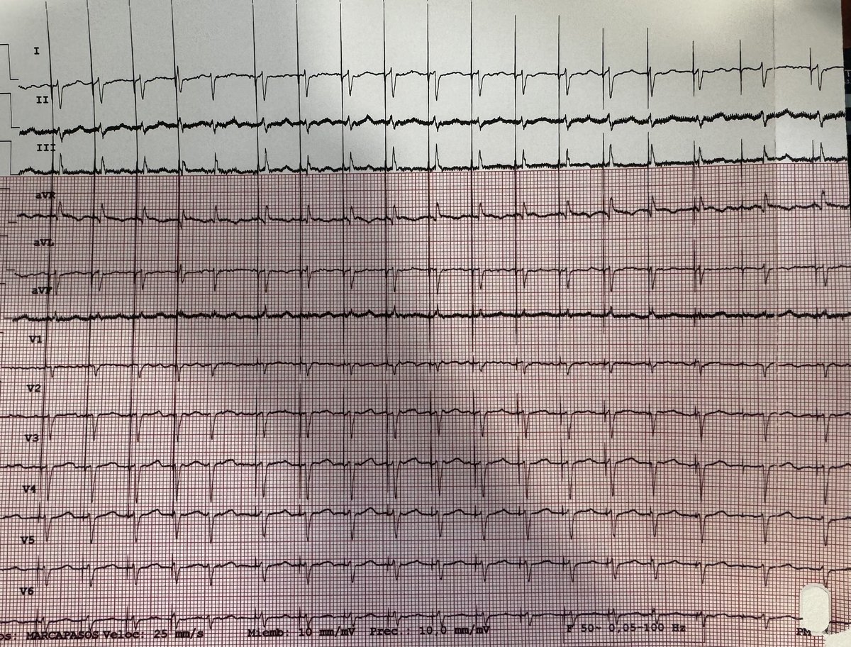 Irene Esteve (@irene_esteve) on Twitter photo Mujer 82 años FA permanente con RvR, varios ingresos por ICC secundaria, FEVIp. ECG basal y ECG tras implante MP VVI con estimulación hisiana selectiva, UME 0.75V@0.4ms. Así la ablación del NAV es otra cosa 👌 <a href="/Dr_Pmorina/">Dr. Pablo Moriña Vázquez</a> #HJRJ Mujer 82 años FA permanente con RvR, varios ingresos por ICC secundaria, FEVIp. ECG basal y ECG tras implante MP VVI con estimulación hisiana selectiva, UME 0.75V@0.4ms. Así la ablación del NAV es otra cosa 👌 <a href="/Dr_Pmorina/">Dr. Pablo Moriña Vázquez</a> #HJRJ