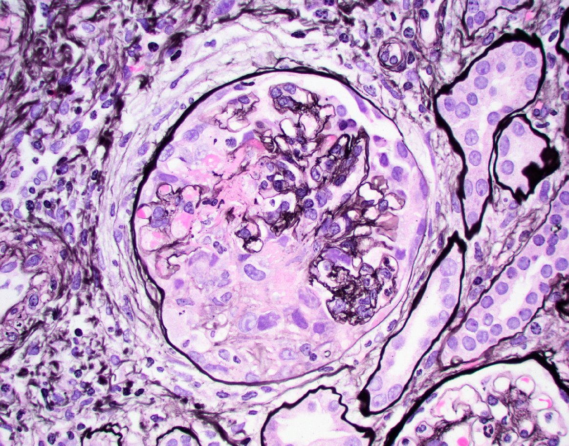 Nice example of medullary angiitis in a case of crescentic pauci immune GN. Characteristic findings include interstitial hemorrhage + PMN rich leukocyte infiltration and karyorrhectic debris. Can also be seen with IgAN, AIN, and cryoGN.  #renalpath #nephrology #pathtwitter