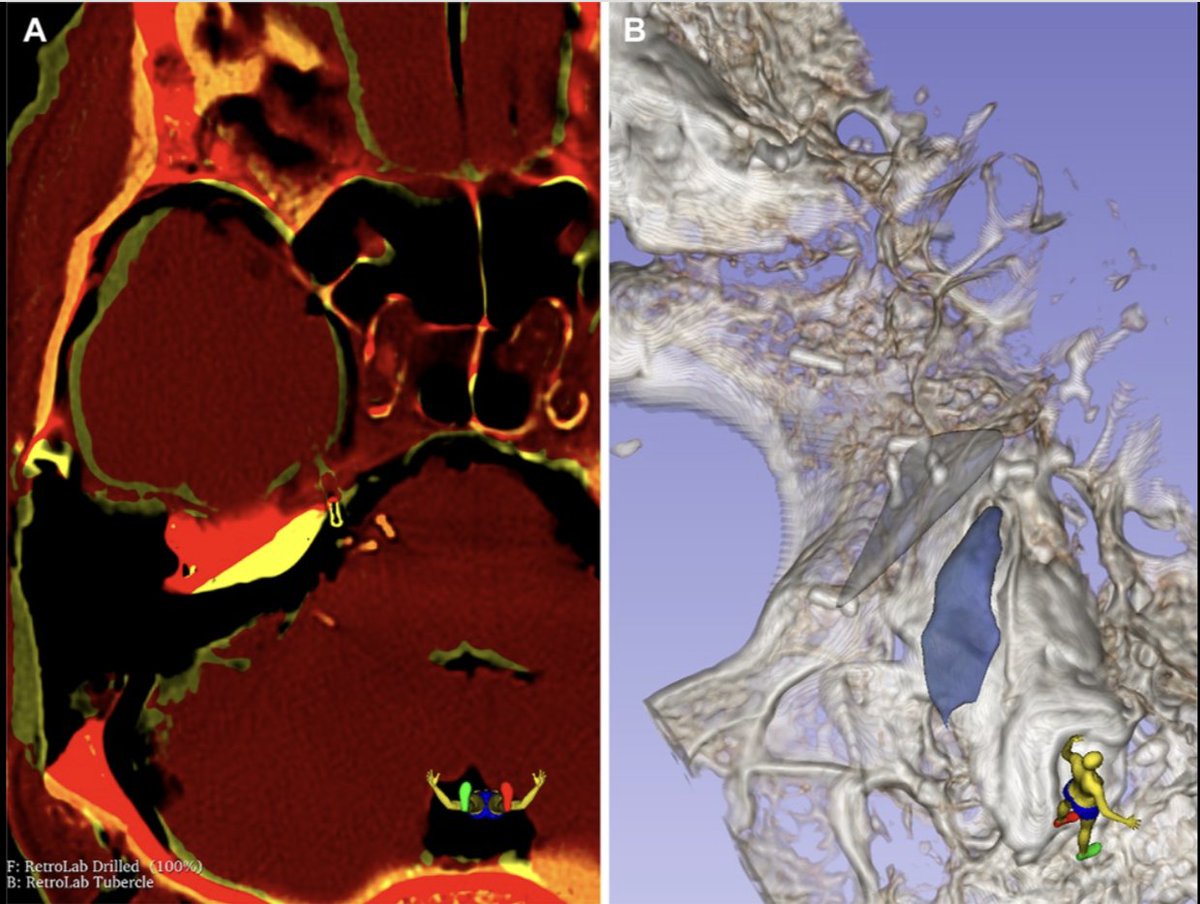 #ONSNew Endoscopic Retrolabyrinthine Craniotomy for Exposure of the Trigeminal Nerve Root Entry Zone: Volumetric Analysis of Anatomic Exposure in the Cadaver bit.ly/4gIFoYB by Chau et al <a href="/HouseInstitute/">House Institute</a> <a href="/cns_update/">CNS</a> <a href="/MdOlabisi/">Olabisi Sanusi MD, FAANS</a> <a href="/e_celano/">Emma Celano</a>