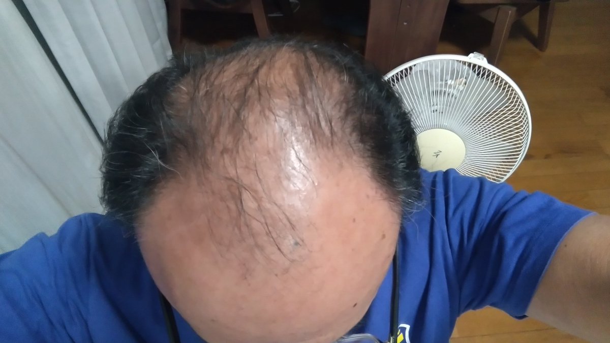 ここまで禿げるとは、
思わなかった…　加賀谷圭(談)