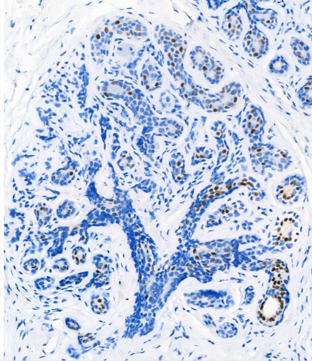 Manchester Breast Centre (@mcrbreastcentre) on Twitter photo Starting #BreastCancerAwarenessMonth off on 1st October with this beautiful โMammary Treeโ image of normal breast tissue grown in the Breast Biology lab <a href="/MCRCnews/">Manchester Cancer Research Centre</a> by Dr Hannah Harrison, <a href="/DrHHarrison/">Hannah Harrison</a> Research Fellow, <a href="/UoM_DCS/">Division of Cancer Sciences</a>, <a href="/FBMH_UoM/">UoM Biology, Medicine and Health</a> Starting #BreastCancerAwarenessMonth off on 1st October with this beautiful โMammary Treeโ image of normal breast tissue grown in the Breast Biology lab <a href="/MCRCnews/">Manchester Cancer Research Centre</a> by Dr Hannah Harrison, <a href="/DrHHarrison/">Hannah Harrison</a> Research Fellow, <a href="/UoM_DCS/">Division of Cancer Sciences</a>, <a href="/FBMH_UoM/">UoM Biology, Medicine and Health</a>