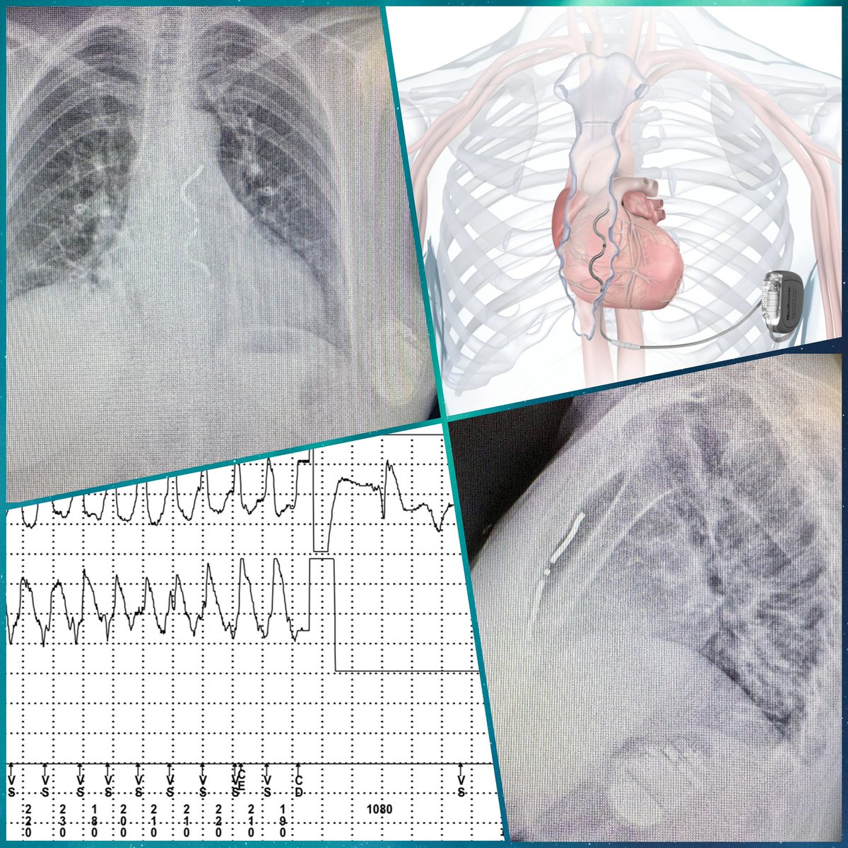Panagiotis Mililis (@ipetemil) on Twitter photo First implantation of Extravascular ICD in #onassiscardiacsurgerycenter. <a href="/MEfraimidis/">Michail Efremidis</a> <a href="/DrAvgerinos/">Dimitrios Avgerinos, MD, PhD, FACS</a> <a href="/K_Letsas/">Konstantinos Letsas</a> <a href="/athsaplaouras/">Athanasios Saplaouras</a> <a href="/SteliosDragasis/">Stelios</a> <a href="/Kariki_O/">Ourania Kariki</a> #EPEEPS <a href="/Medtronic/">Medtronic</a> First implantation of Extravascular ICD in #onassiscardiacsurgerycenter. <a href="/MEfraimidis/">Michail Efremidis</a> <a href="/DrAvgerinos/">Dimitrios Avgerinos, MD, PhD, FACS</a> <a href="/K_Letsas/">Konstantinos Letsas</a> <a href="/athsaplaouras/">Athanasios Saplaouras</a> <a href="/SteliosDragasis/">Stelios</a> <a href="/Kariki_O/">Ourania Kariki</a> #EPEEPS <a href="/Medtronic/">Medtronic</a>