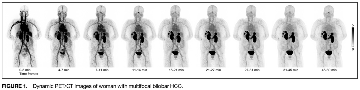DrMHofman's tweet photo. New GA-68 GPC3 peptide first-in-human series:
https://t.co/D1tVZVDUNv @JournalofNucMed 

19 patients with hepatocellular carcinoma: mean SUVmax 20 (range 3 - 95) https://t.co/alUq6AERhr