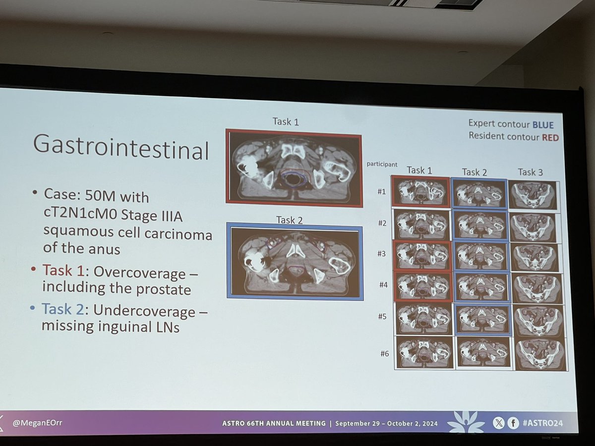 Great topic by <a href="/MeganEOrr/">Megan Orr</a> on patterns of contouring mistakes in novice residents in #radonc 

GI example: some over, under contouring for target volumes