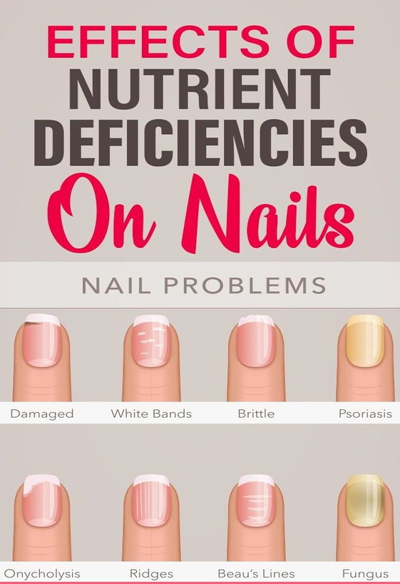NailCare1991's tweet photo. Effects Of Nutrient Deficiencies On Nails: Their shape, texture, color, growth rate – everything is a sign that your body is screaming for nutrients. Most nail and skin changes occur due to vitamin and nutrient deficiency. #Nails #NailCare #NutritionDeficiency #NailCareTips https://t.co/SX52t9kc4n
