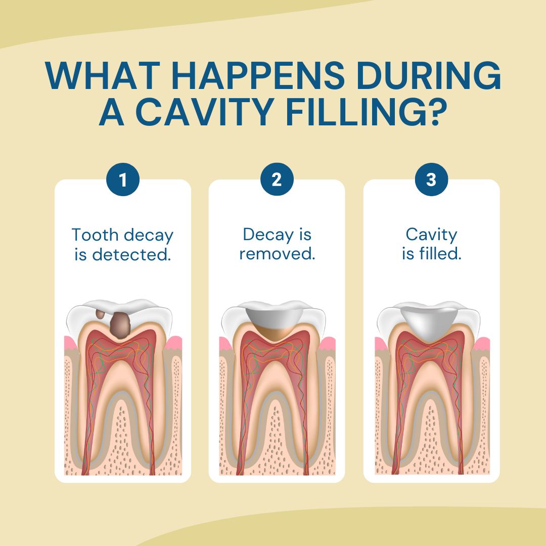 GenerationDent's tweet image. Getting a cavity filled is easy as 1-2-3 at Generations Dental! During your appointment, our team will remove the decayed portion of your tooth and fill the cavity with a dental filling material, such as composite resin, amalgam, or porcelain. Call: 208-664-9225.