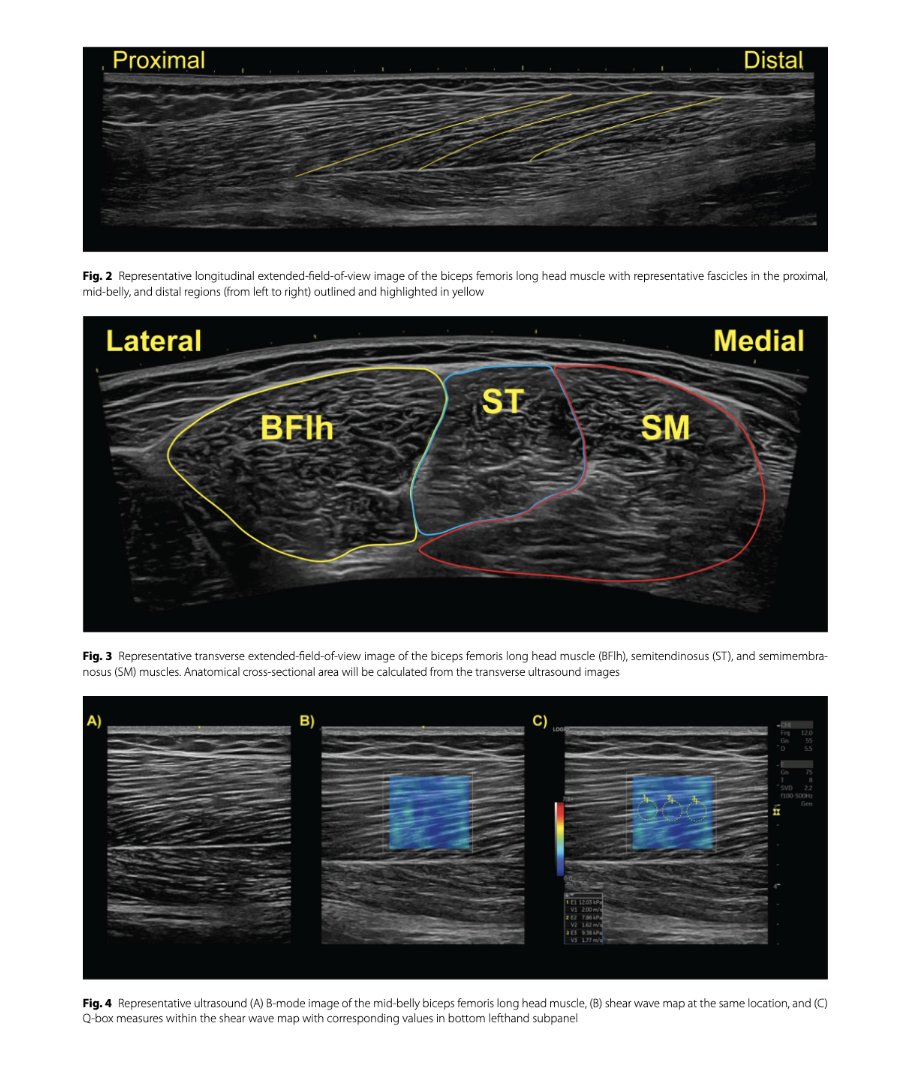 🔝"The study protocol investigated the effects of a 6-week training program using either the hip-dominant Romanian deadlift or Nordic-HE on hamstring strain injury risk factors &amp; sprint performance" 
👉S. Crawford et al, 2023 🇺🇸
<a href="/BMC_series/">BMC Series</a> 
📂Open Access: …sportsscimedrehabil.biomedcentral.com/articles/10.11…