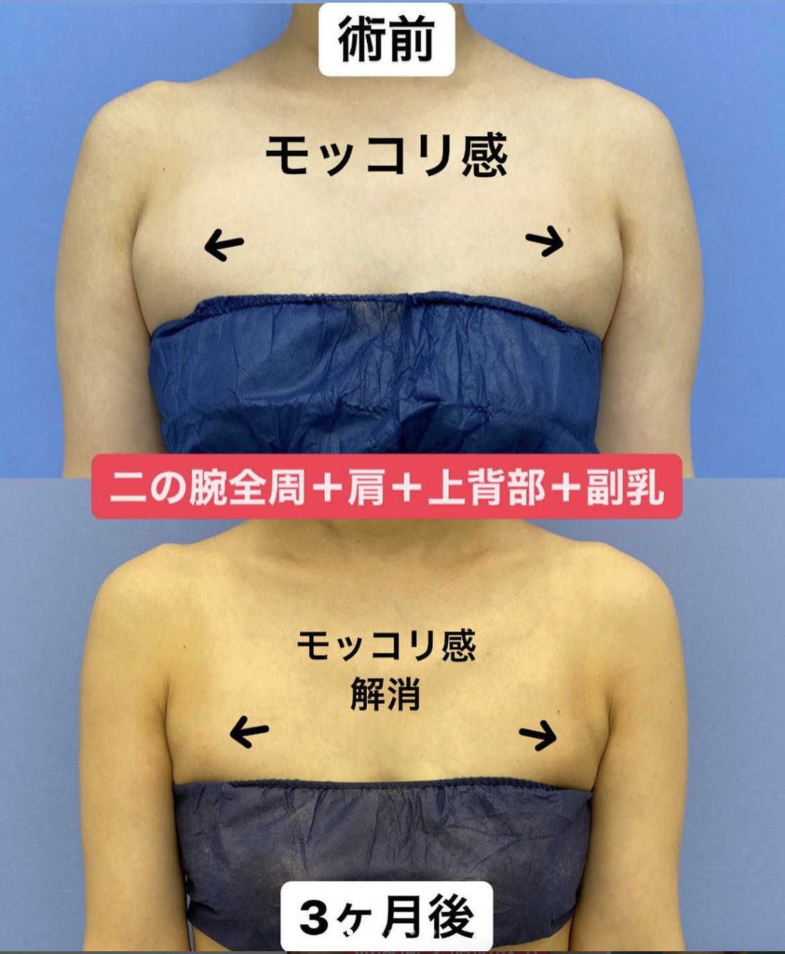 副乳 