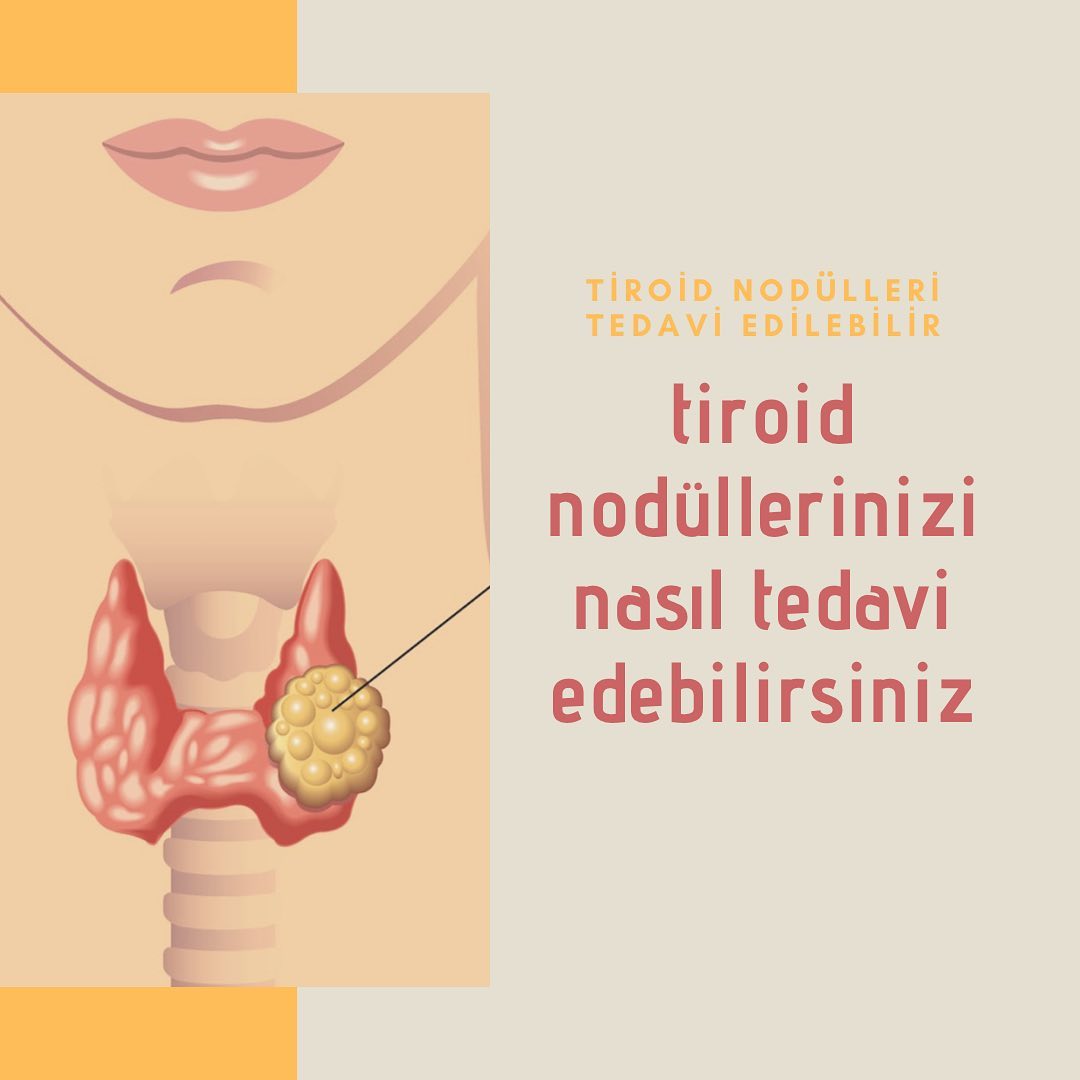 Tiroid nodülleri de dahil olmak üzere tiroid hastalıklarının tamamının altında iyot eksikliği önemli bir nedendir.Tiroid nodüllerine genellikle hipotiroid , hashimato tiroidi gibi nedenler eşlik ederler. 

Tiroidin tüm hastalıklarının tedavisinde uygun doz iyot kullanılması