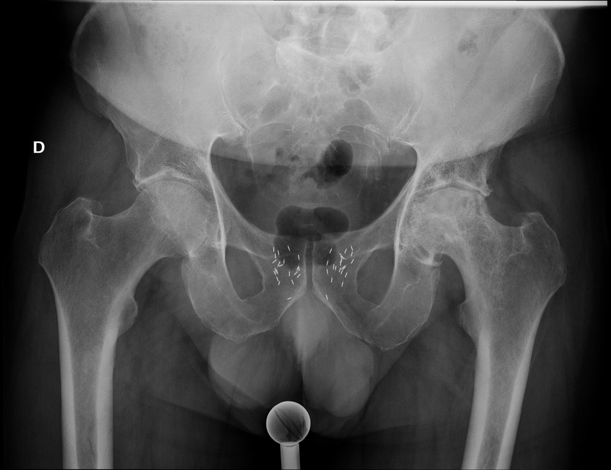 ClinicaCEMTRO's tweet photo. 🤖Primera prótesis total de cadera por abordaje anterior directo asistida por robot #MakoSmartRobotics de España por el @drluisnovoar
💻Conoce más sobre ello en la siguiente noticia:
https://t.co/plr4PLCaWT https://t.co/615jc2O8hf