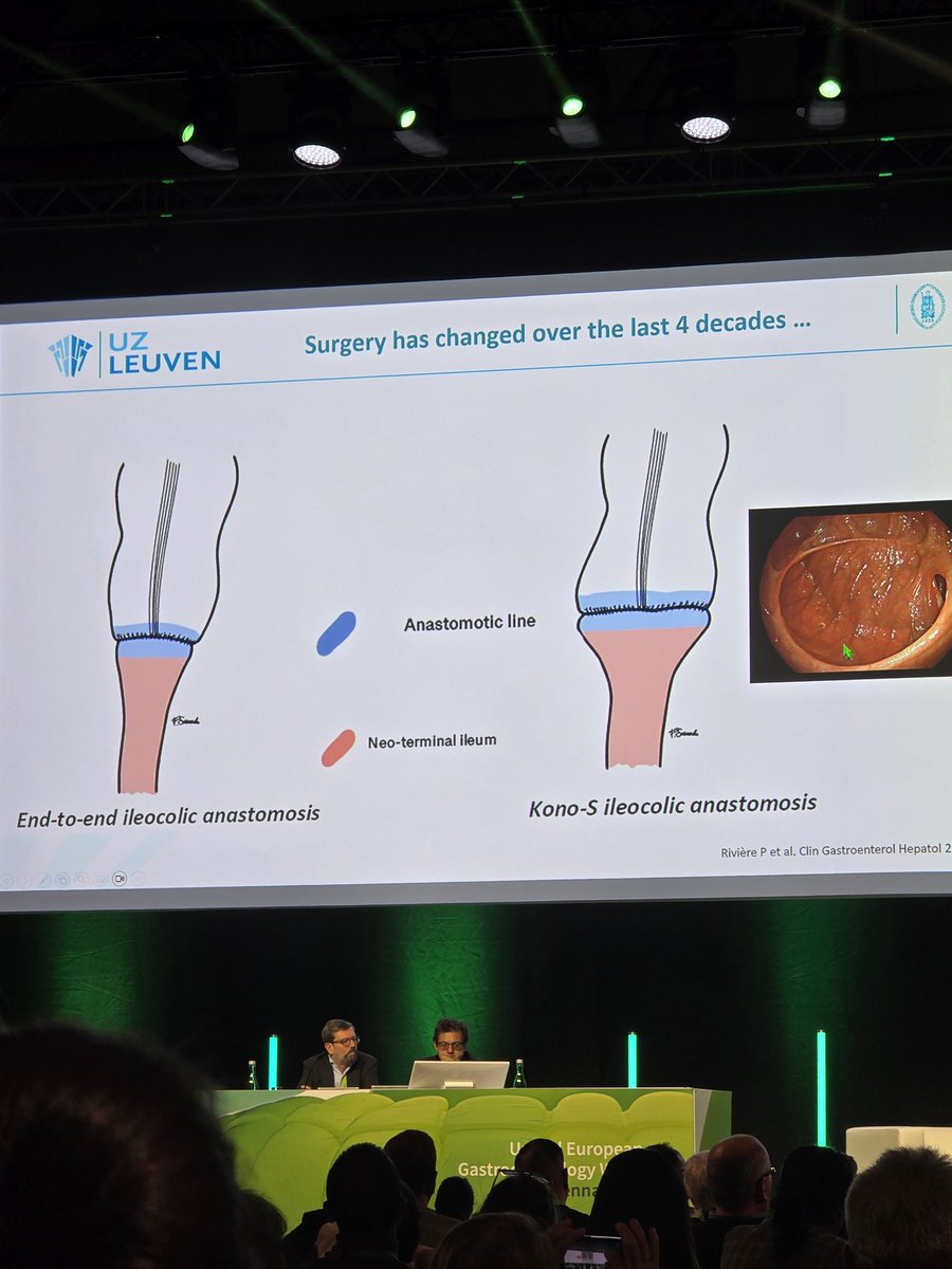 6-month post-op ileocolonoscopy 🔭 is still THE gold standard for assessing post-op Crohn's recurrence. But watch out for intestinal ultrasound making waves 👀

The main challenge is all the new surgical anastomotic techniques - our endoscopic scores haven't kept up 🏎️ #uegweek