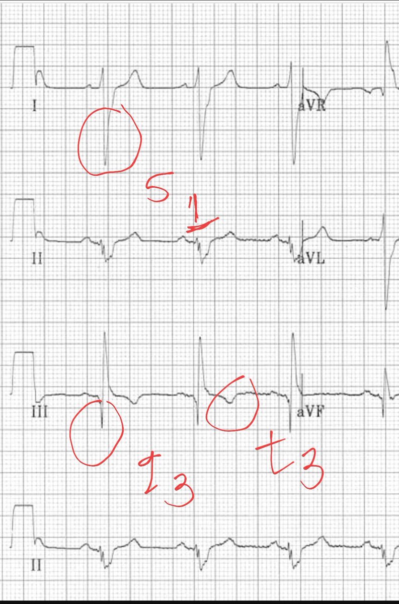 @Gazelle6849 🇵​​🇺​​🇱​​🇲​​🇴​​🇳​​🇦​​🇷​​🇾​ ​ 🇪​​🇲​​🇧​​🇴​​🇱​​🇮​​🇸​​🇲​

📌INTRODUCTION 
📍Pulmonary embolism (PE) is a life threatening medical condition 📍One or more arteries in the lungs become blocked by a blood clot. 
📍The clot usually travels from the legs or other parts of