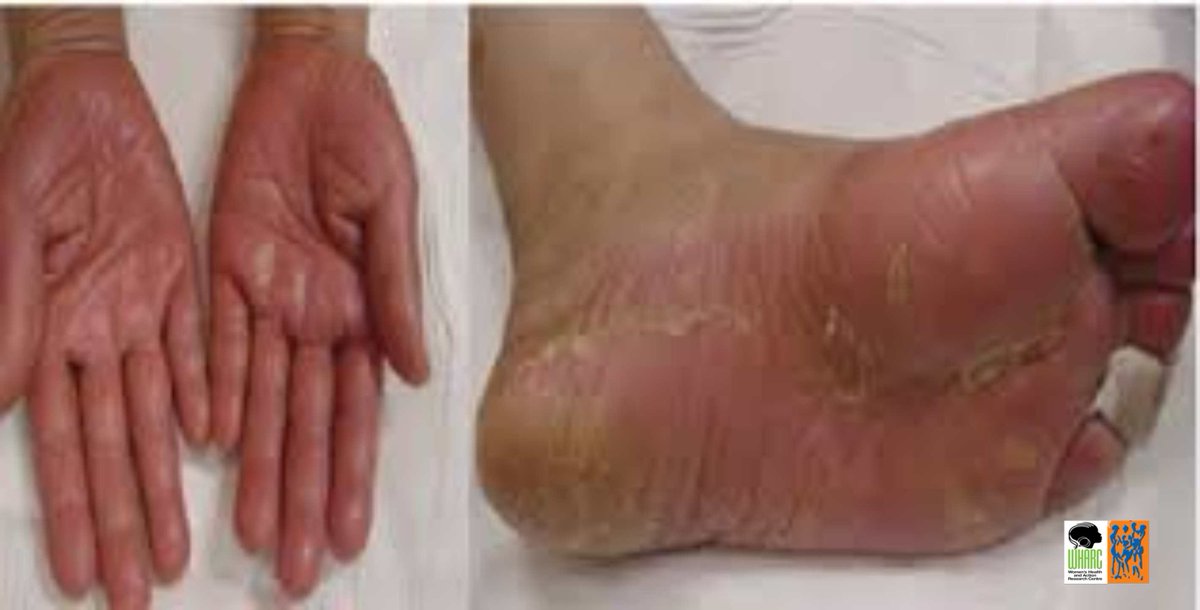 Impact of comprehensive nursing on hand-foot syndrome caused by oral capecitabine in breast cancer patients.

This study examines the effects of comprehensive nursing care on hand-foot syndrome (HFS) in breast cancer... ajrh.info/index.php/ajrh…
<a href="/feokonofua/">Friday Okonofua</a>
