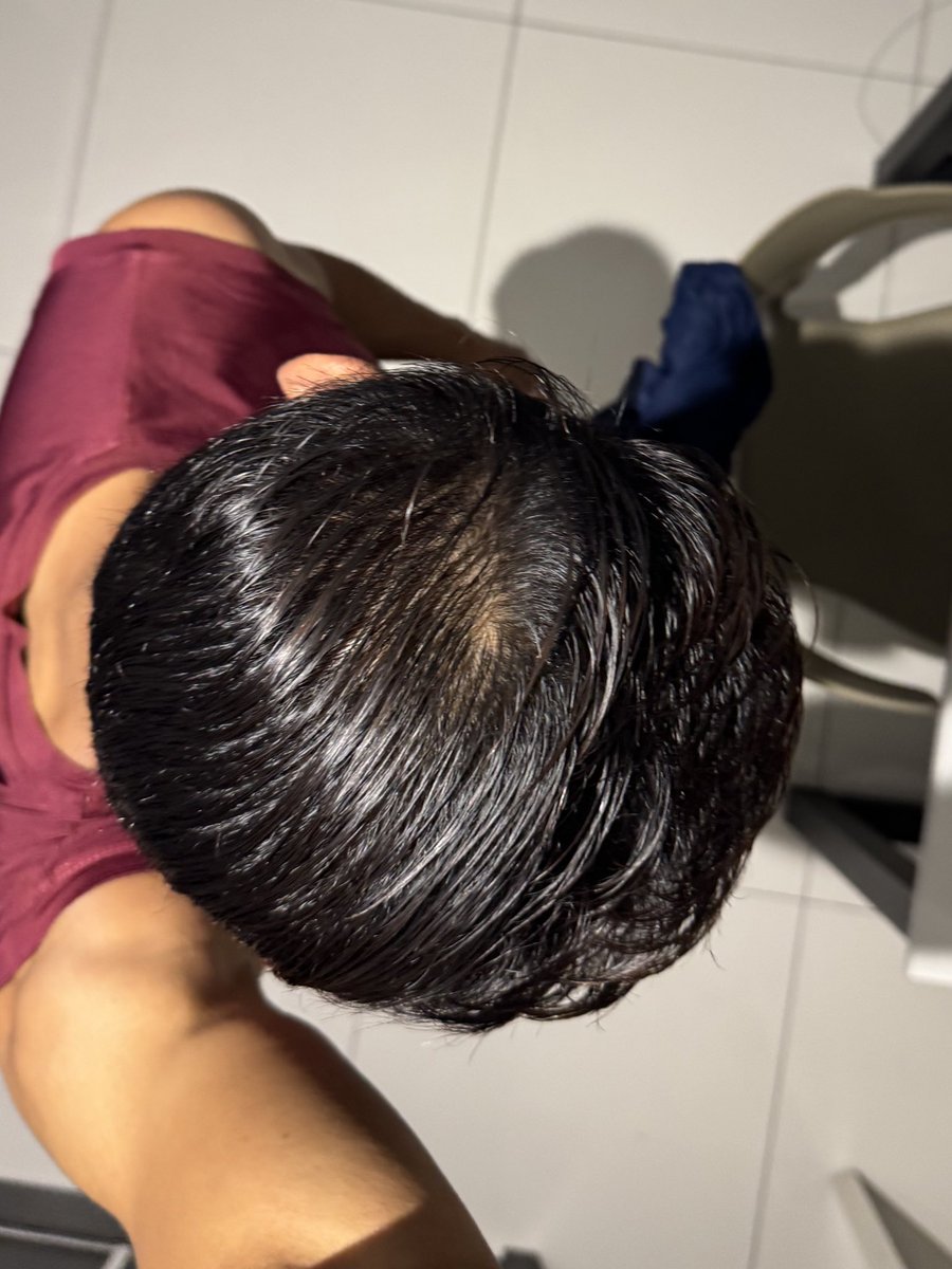 Update ‼️

Kiri bulan 7 haritu and kanan harini.
For me, mmng ada perubahan.
Rambut tak rasa nipis and more volume. Mind you yg kanan tu rambut time basah and bawah lampu.

Thanks to this 👇🏼