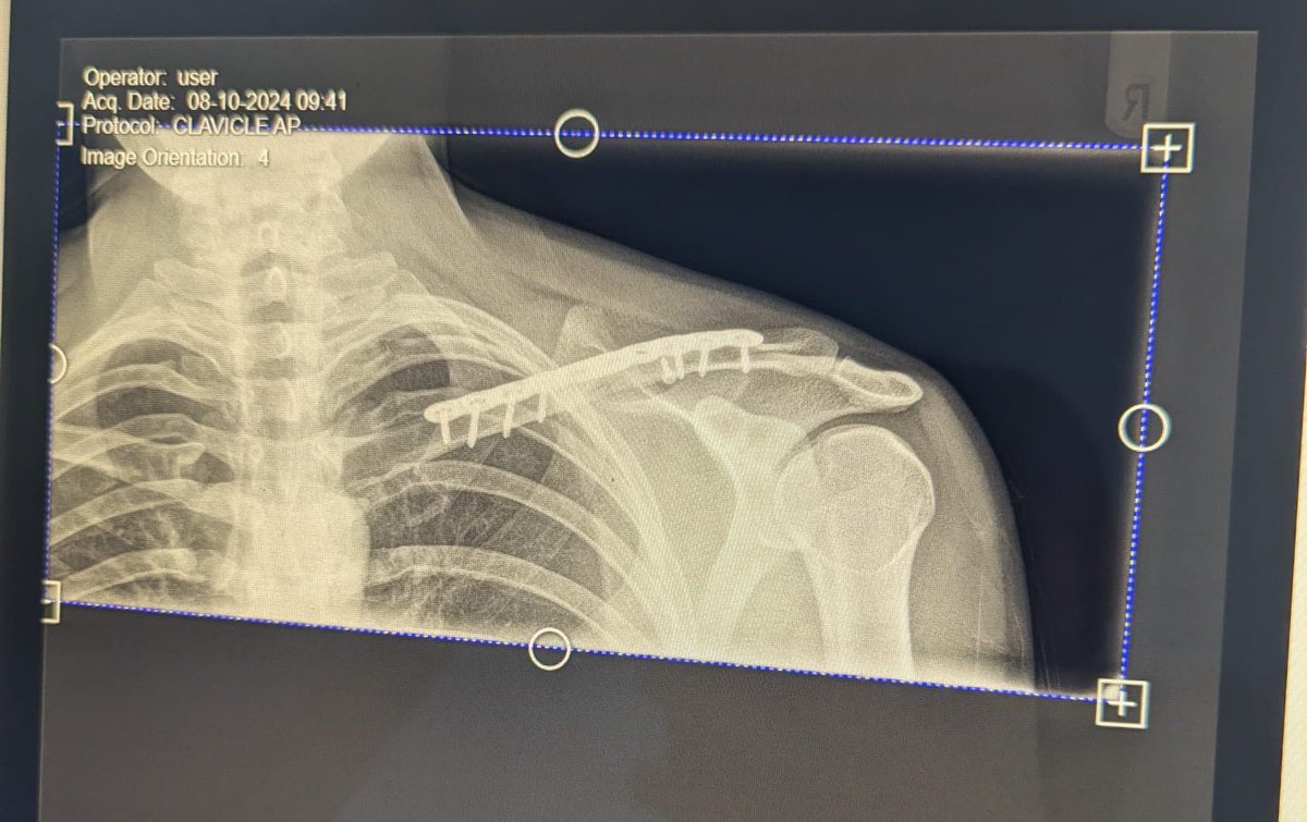 South London Royals (@slroyalsfc) on Twitter photo Our CDM the suffered a fracture of the collar bone result in it breaking into 4 piece has had surgery and now is on the road to recovery 🙌🏽 thank you for all the well wishes! Hopefully have you back in the pitch with us soon double plated up <a href="/A_steele_94/">Andrew Steele</a> Our CDM the suffered a fracture of the collar bone result in it breaking into 4 piece has had surgery and now is on the road to recovery 🙌🏽 thank you for all the well wishes! Hopefully have you back in the pitch with us soon double plated up <a href="/A_steele_94/">Andrew Steele</a>