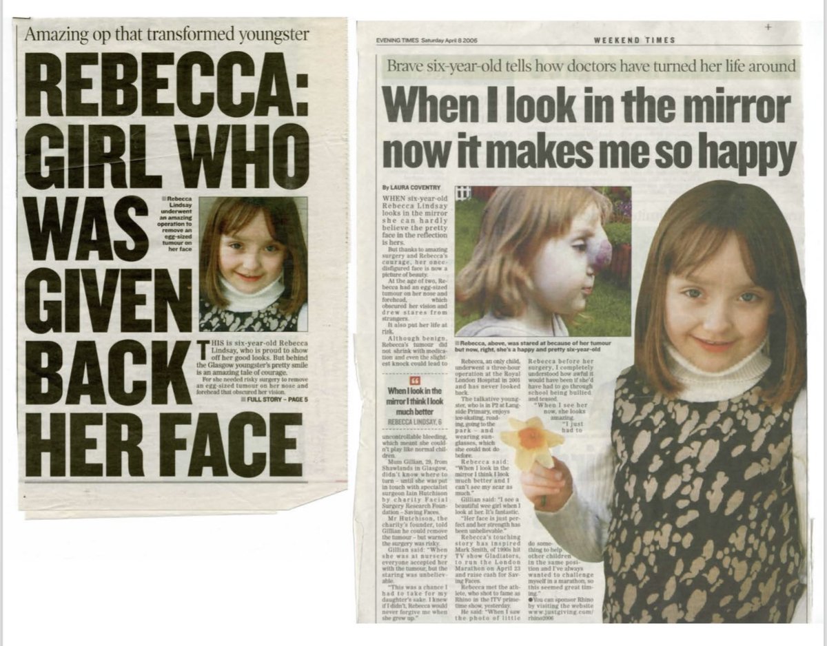 Rebecca's Story: Diagnosed as baby with life-threatening haemangioma. Life-saving surgery at 3 years old changed everything. Now, Saving Faces launches Alan Rickman Professorship named after Patron to research treatment innovations &amp; save lives. Donate now: