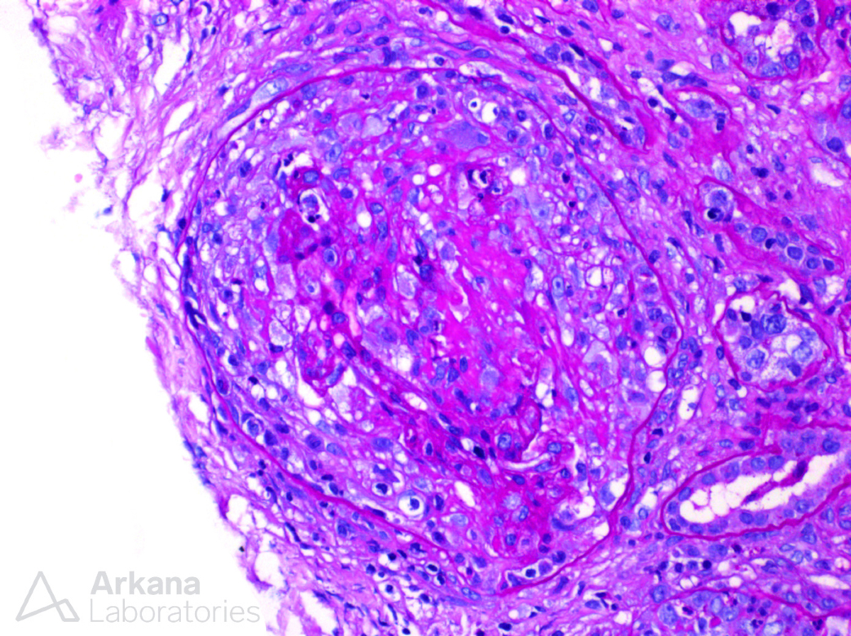 arkanalabs's tweet image. In the presence of a negative immunofluorescence panel, what is your diagnosis?

#DiagnoseThis #renalpath #nephropath