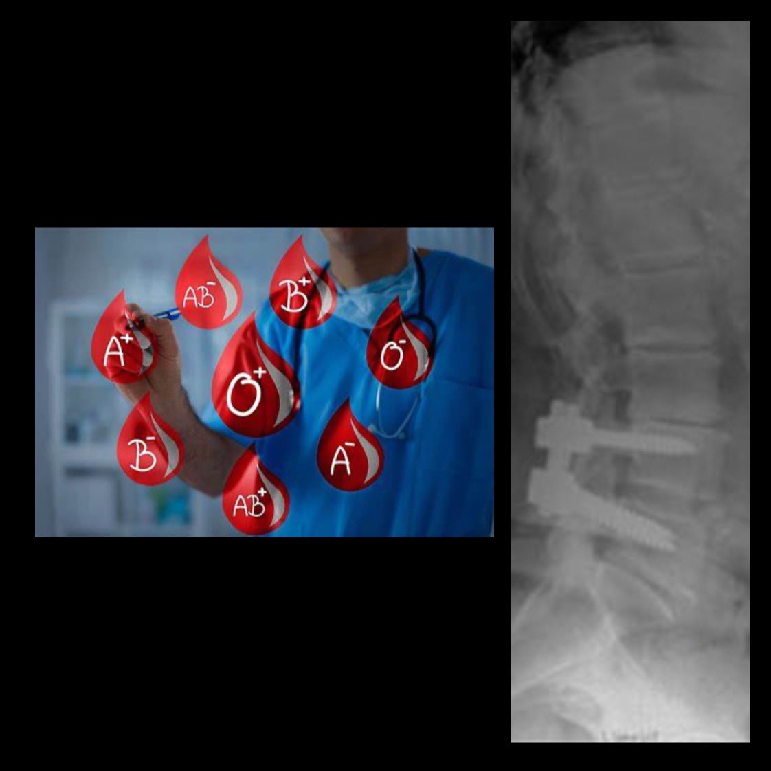 Dino Samartzis (@dinosamartzis) on Twitter photo Is “BLOOD TYPE” a risk factor for new spine degeneration and pain after surgery? Our study found that it is!
“Is ABO blood type a risk factor for adjacent segment degeneration after lumbar spine fusion?” <a href="/EurSpineJournal/">European Spine J</a>
link.springer.com/article/10.100…
<a href="/MOR_Docs/">Midwest Orthopaedics at Rush</a> <a href="/RUOrthoResearch/">RUSH Orthopedic Research</a> Is “BLOOD TYPE” a risk factor for new spine degeneration and pain after surgery? Our study found that it is!
“Is ABO blood type a risk factor for adjacent segment degeneration after lumbar spine fusion?” <a href="/EurSpineJournal/">European Spine J</a>
link.springer.com/article/10.100…
<a href="/MOR_Docs/">Midwest Orthopaedics at Rush</a> <a href="/RUOrthoResearch/">RUSH Orthopedic Research</a>