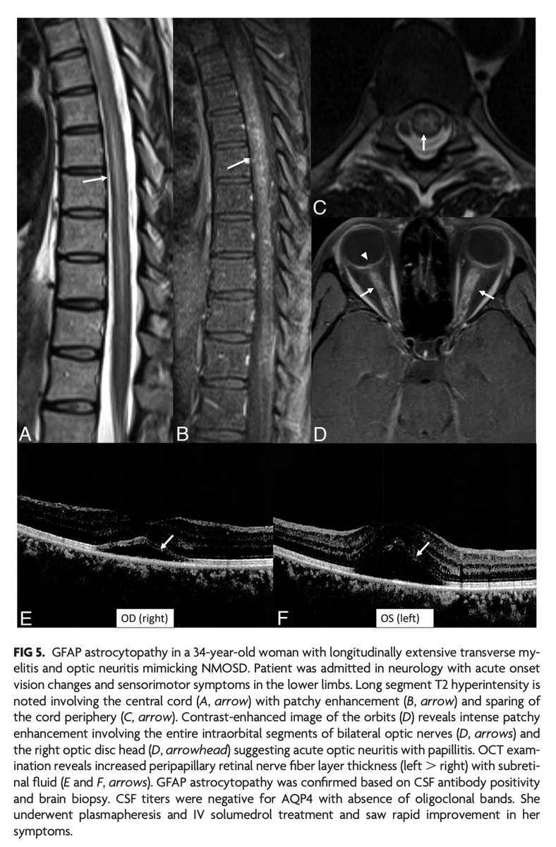 "Glial Fibrillary Acidic Protein Astrocytopathy: Review of Pathogenesis, Imaging Features, and Radiographic Mimics"

doi.org/10.3174/ajnr.A…

@amitagarwalmd; @mayoradiology #FellowsJournalClub