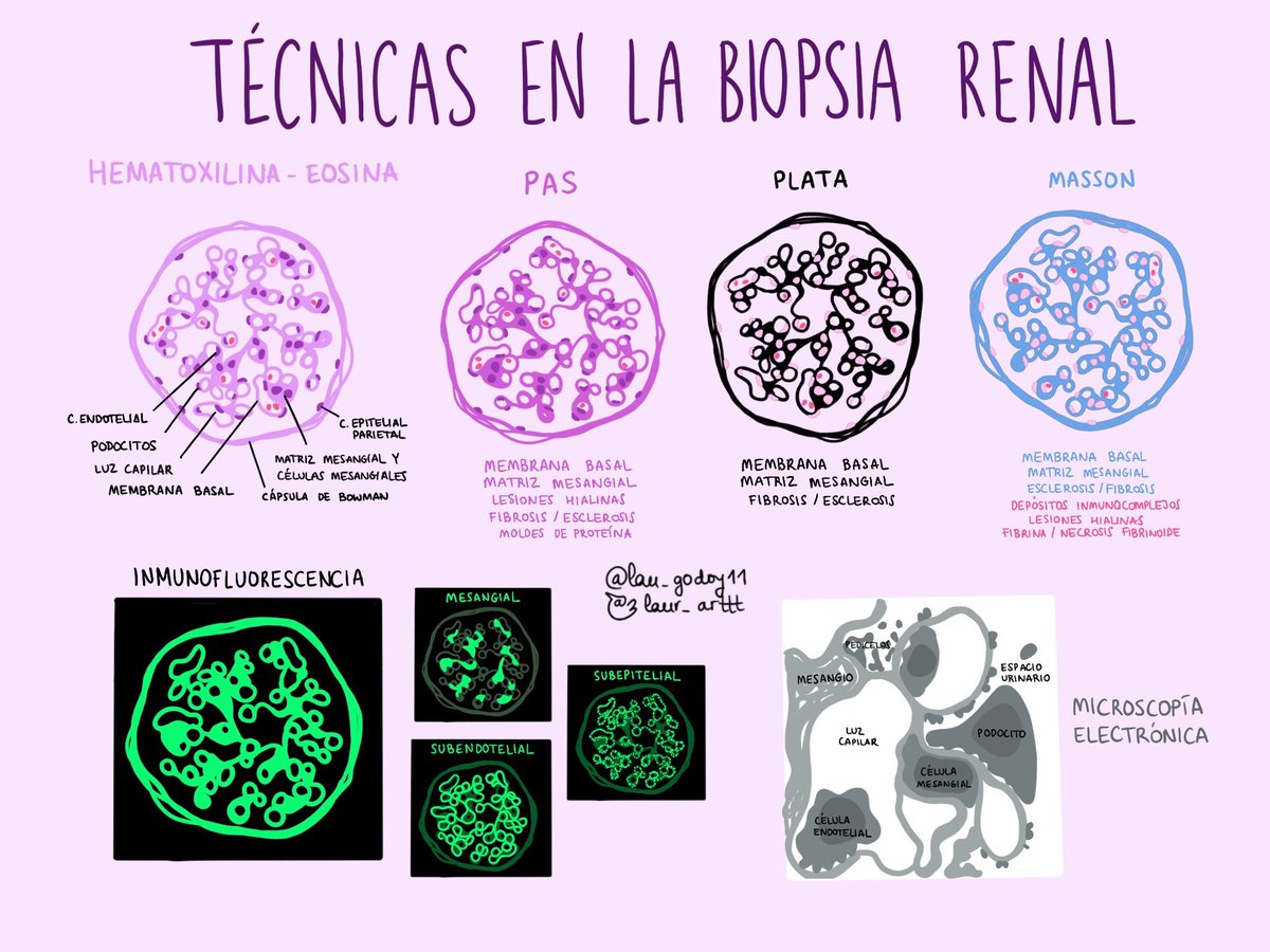 lau_godoy11's tweet image. Después de mucho tiempo he vuelto a dibujar así que por aquí os dejo unos simpáticos esquemas de biopsias renales, espero que os gusten 🥰

(Intentaré ir subiendo algún dibujillo más)
 #path #renalpath #nephropath #nephrology
#pathology #histology