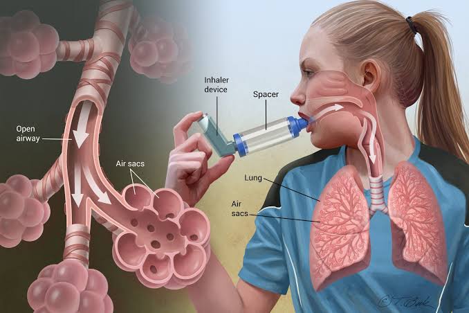 ASTHMA  is a life-threatening condition that requires optimum  care and attention 

It is a chronic inflammatory disease that narrows the airways to your  Lungs.

When a person has asthma,