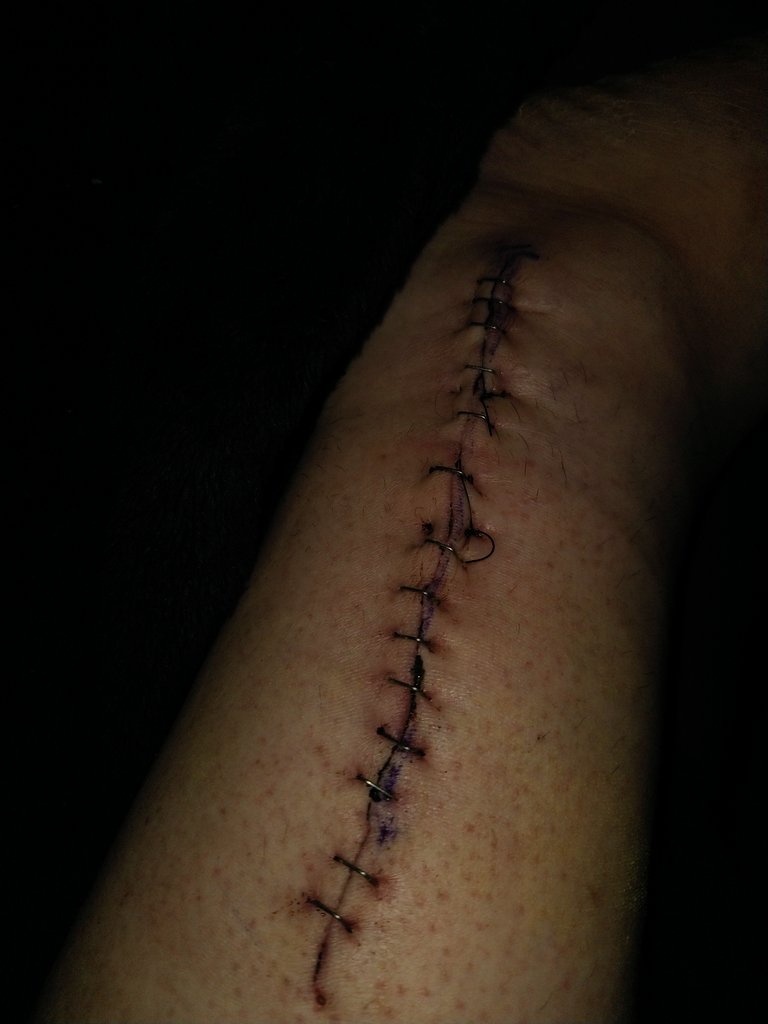 Post surgery leg stitch job image

1st time I opened my leg wrap, even the pain wasn't as bad as the smell 🦨 🤢  🤕 I am not saying I would do better, but compared to my throat this was like a first attempt. It looks hastily slapped together. Dr was late 50s. Oof I shouldn't be