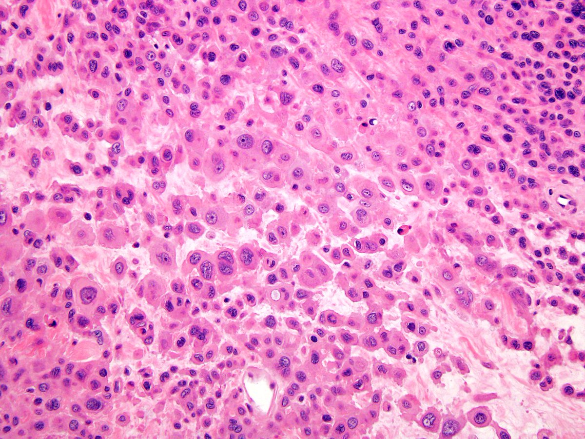 ST mass, inguinal. KRT+/loss of INI.  Nice example of proximal-type
