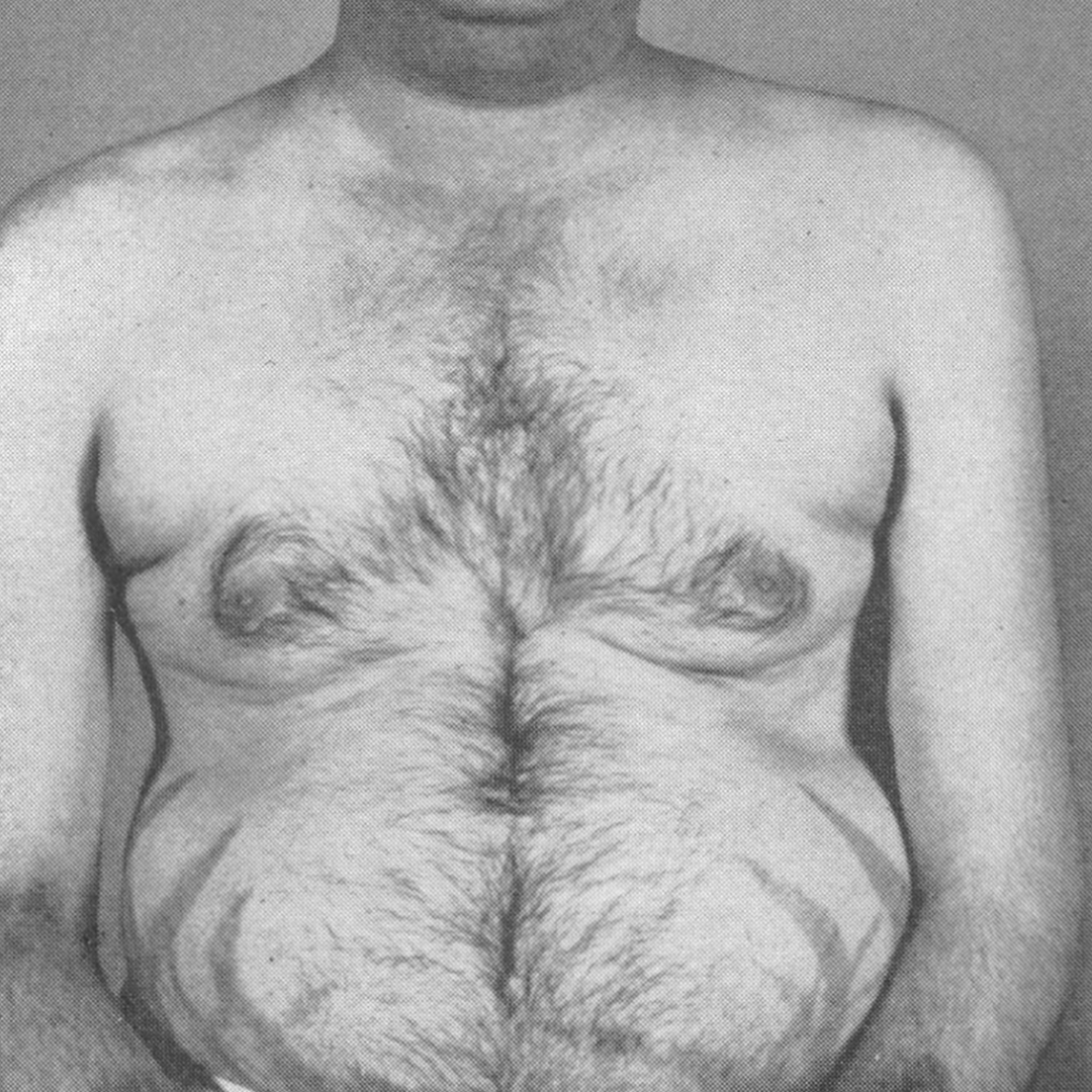 NEJM's tweet photo. From the NEJM Archive: Cushing's Syndrome Due to an ACTH-Secreting Chromophobe Adenoma — Report of a Case Treated by Hypophysectomy (Original Article, October 4, 1962) https://t.co/2TkAf4mJ4w https://t.co/V12LJQVdzH