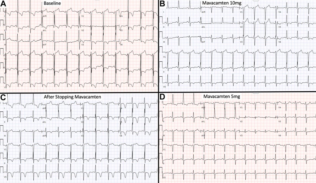 Difficult to demonstrate true disease modification in any lower risk disease state, esp among younger-to-middle age adults

Intriguing N-of-1-trial-like observation here of normalization of LVH electrocardiographic signature w CMI mavacamten w recurrence upon its discontinuation.