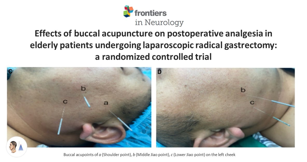 🔀Essai contrôlé randomisé🇨🇳
📰Am J Obstet Gynecol MFM
Douleurs post-opératoires du sujet âgé [gastrectomie radicale par laparoscopie]. Efficacité de l’acupuncture [A] préopératoire 𝑣𝑠 absence de [A].  ↘ douleur, dose de sufentanil, temps de réveil. 

pubmed.ncbi.nlm.nih.gov/38984037/🔓
