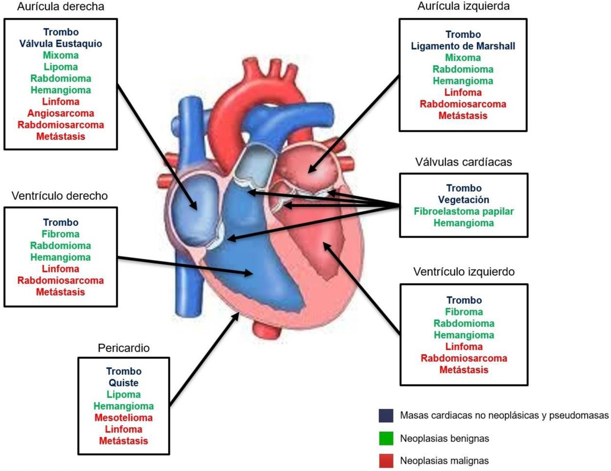REC Publications (@revespcardiol) on Twitter photo Masas cardiacas: diagnóstico, pronóstico y tratamiento #reccardioclinics <a href="/igle_carla/">Carla Iglesias</a> <a href="/Fcalvoiglesias/">Francisco Calvo</a> <a href="/AndresIniguezR/">Andrés Íñiguez Romo</a> reccardioclinics.org//es-masas-card… Masas cardiacas: diagnóstico, pronóstico y tratamiento #reccardioclinics <a href="/igle_carla/">Carla Iglesias</a> <a href="/Fcalvoiglesias/">Francisco Calvo</a> <a href="/AndresIniguezR/">Andrés Íñiguez Romo</a> reccardioclinics.org//es-masas-card…