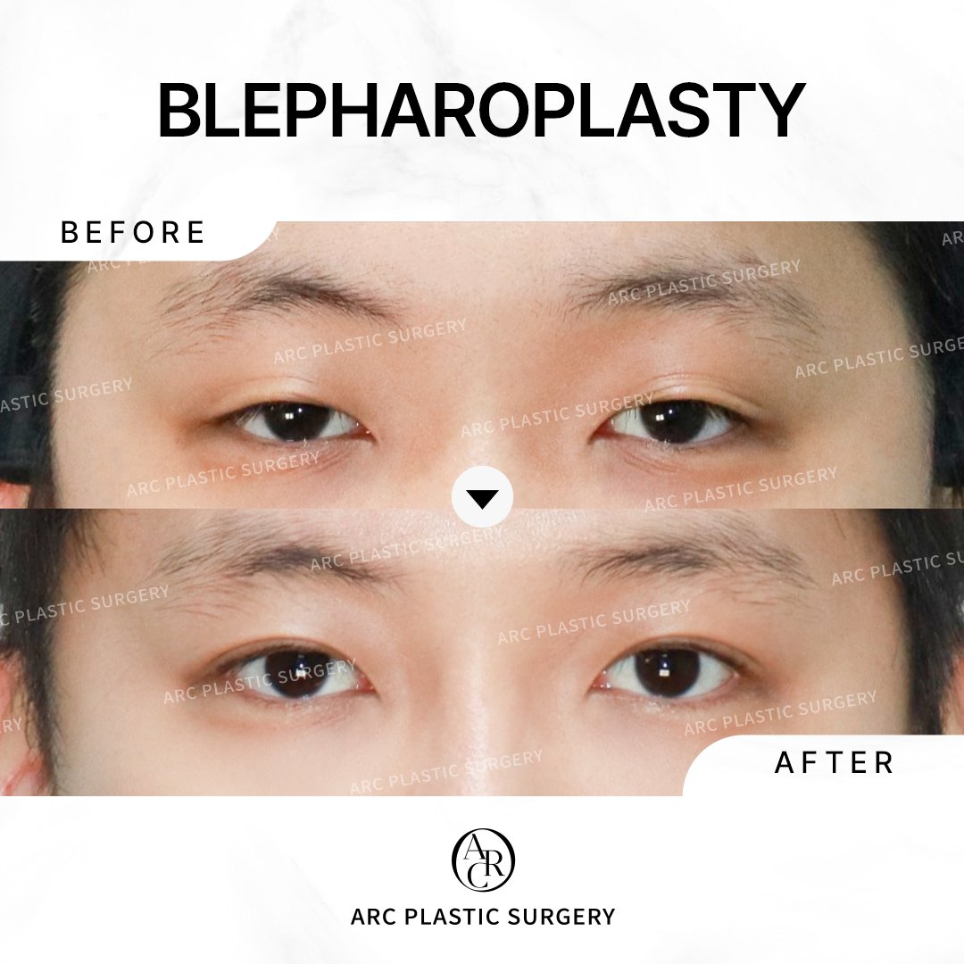 dr_kwonsoonbeom's tweet photo. [FINE ARC]
Blepharoplasty
✔Performed by Dr. Kwon Soon Beom
***********
-non-incisional method
-ptosis correction
-in-line fold
***********
#arcplasticsurgery #drkwonsoonbeom #koreaplasticsurgery #doubleeyelid #blepharoplasty #ptosiscorrection https://t.co/yeqgJWLpRX